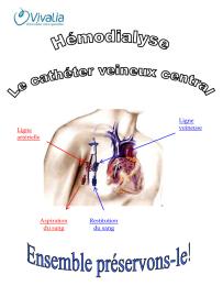 Hémodialyse : La cathéter veineux central