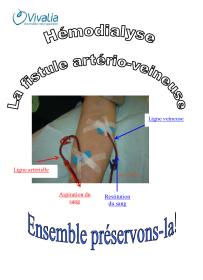 Hémodialyse : La fistule artério-veineuse