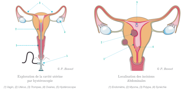 Hysteroscopie | Vivalia