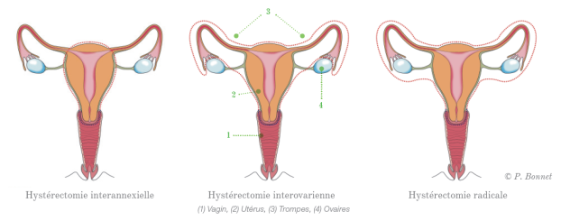 Hysterectomie