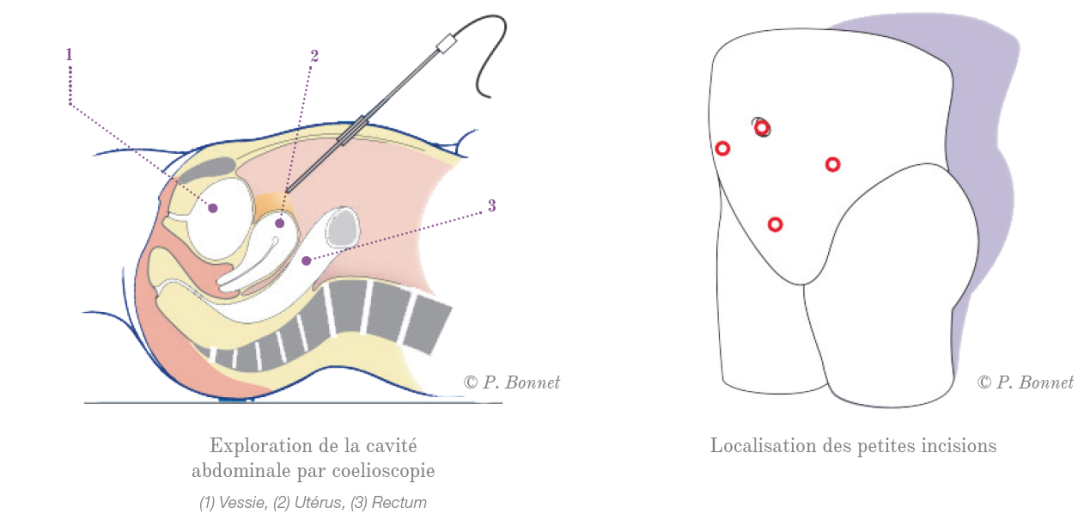 Coelioscopie | Vivalia