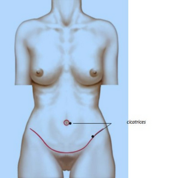 abdominoplastie-v3